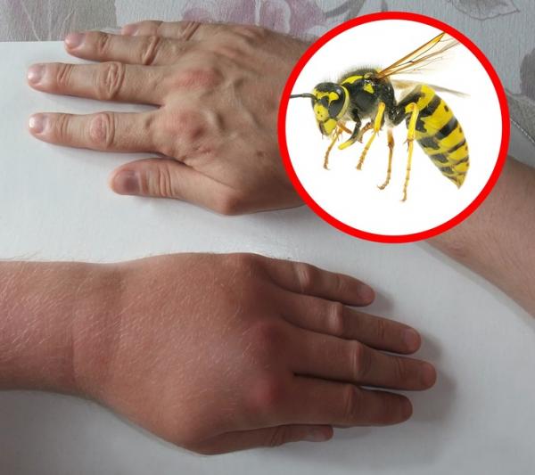 Nhìn vết cắn, 'điểm mặt chỉ tên' ngay loại côn trùng vừa cắn mình Nhìn vết cắn, 'điểm mặt chỉ tên' ngay loại côn trùng vừa cắn mình