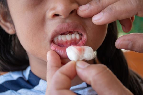 Nếu bạn thường xuyên bị chảy máu nướu, hãy thử áp dụng ngay 10 tip đơn giản này Nếu bạn thường xuyên bị chảy máu nướu, hãy thử áp dụng ngay 10 tip đơn giản này